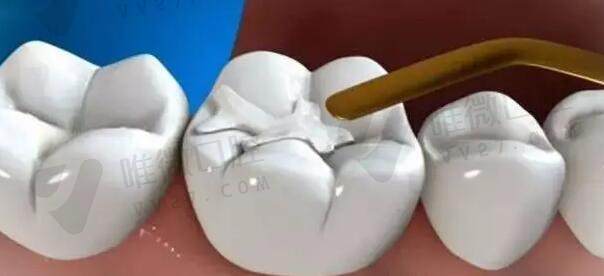 门牙是假牙还可以进行矫正吗,活动假牙的牙槽如何选择材料？小知识！(图1)