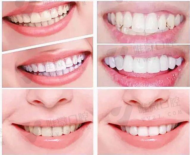 惠州丽雅口腔门诊部：多颗牙缺失矫正，一般市场价格是多少？