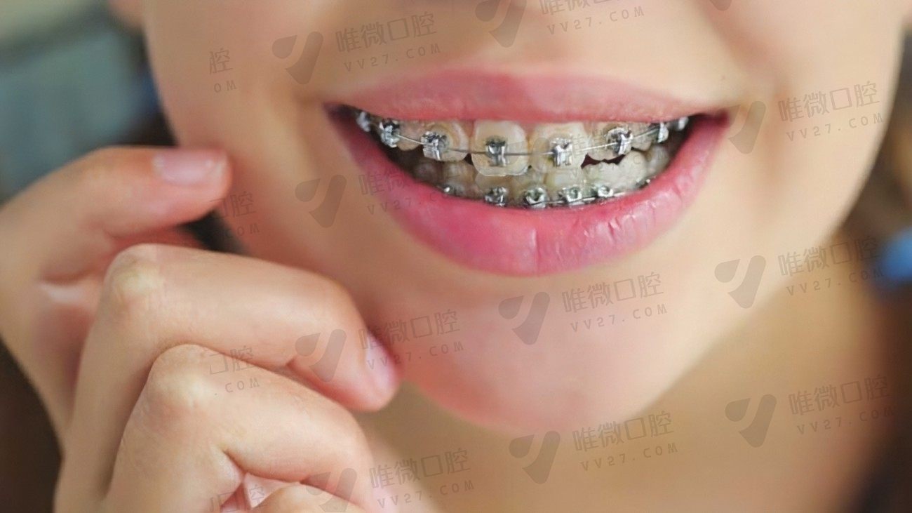 福清茉莉口腔：牙齿畸形矫正，一次矫正多少钱？