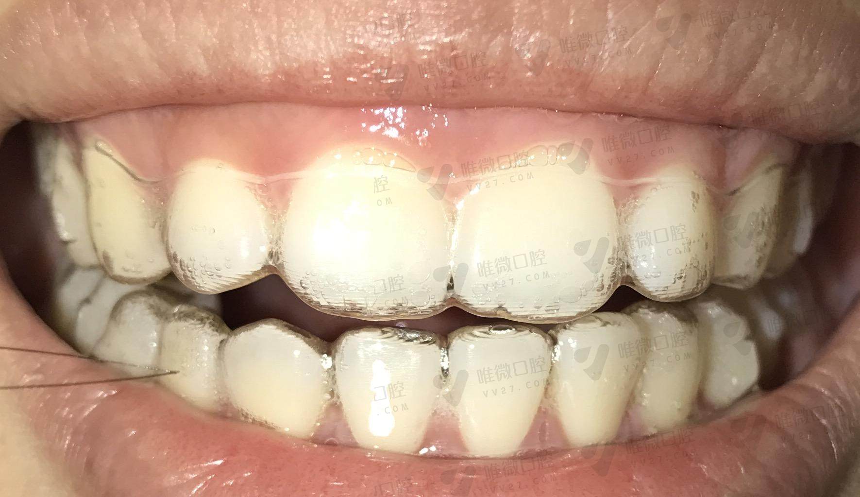 广东中能建电力医院口腔科——镶牙牙床骨凸出矫正，预计需要多少钱？